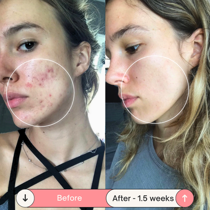 BeautyPro 2.0 - High Frequency Wand - Enjewl