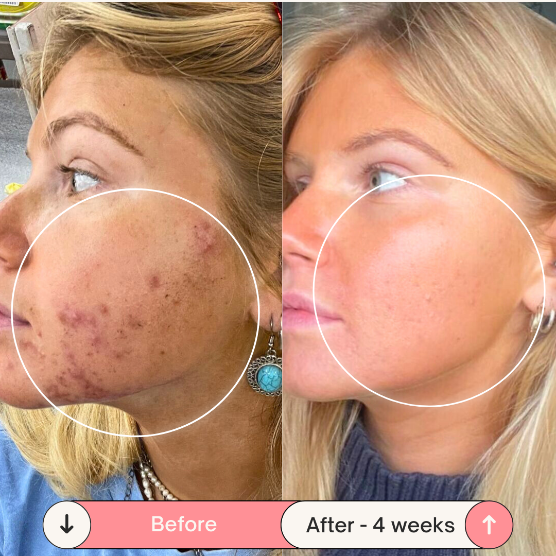 BeautyPro 2.0 - High Frequency Wand - Enjewl