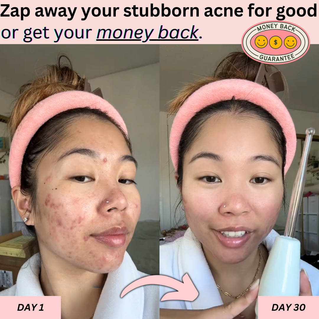 BeautyPro 2.0 - High Frequency Wand - Enjewl