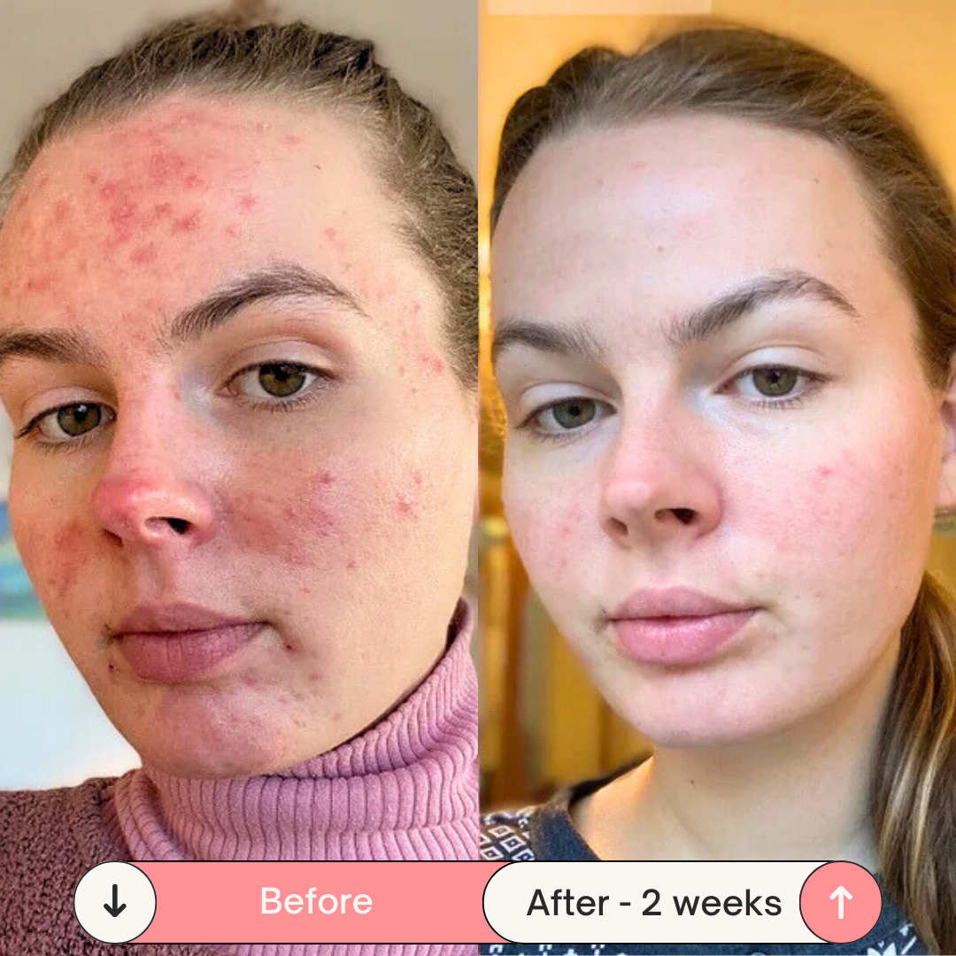 BeautyPro 2.0 - High Frequency Wand - Enjewl