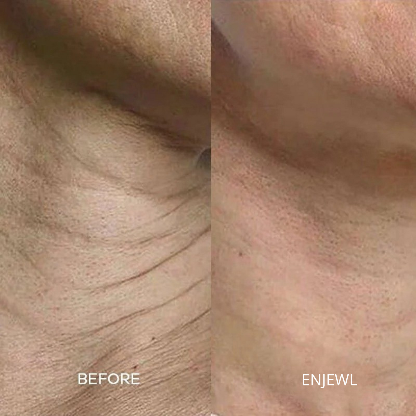 Enjewl™ | Clinical Beauty Filler - Enjewl