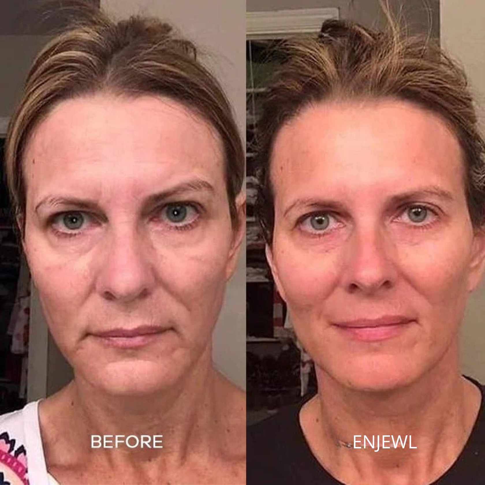 Enjewl™ | Clinical Beauty Filler - Enjewl