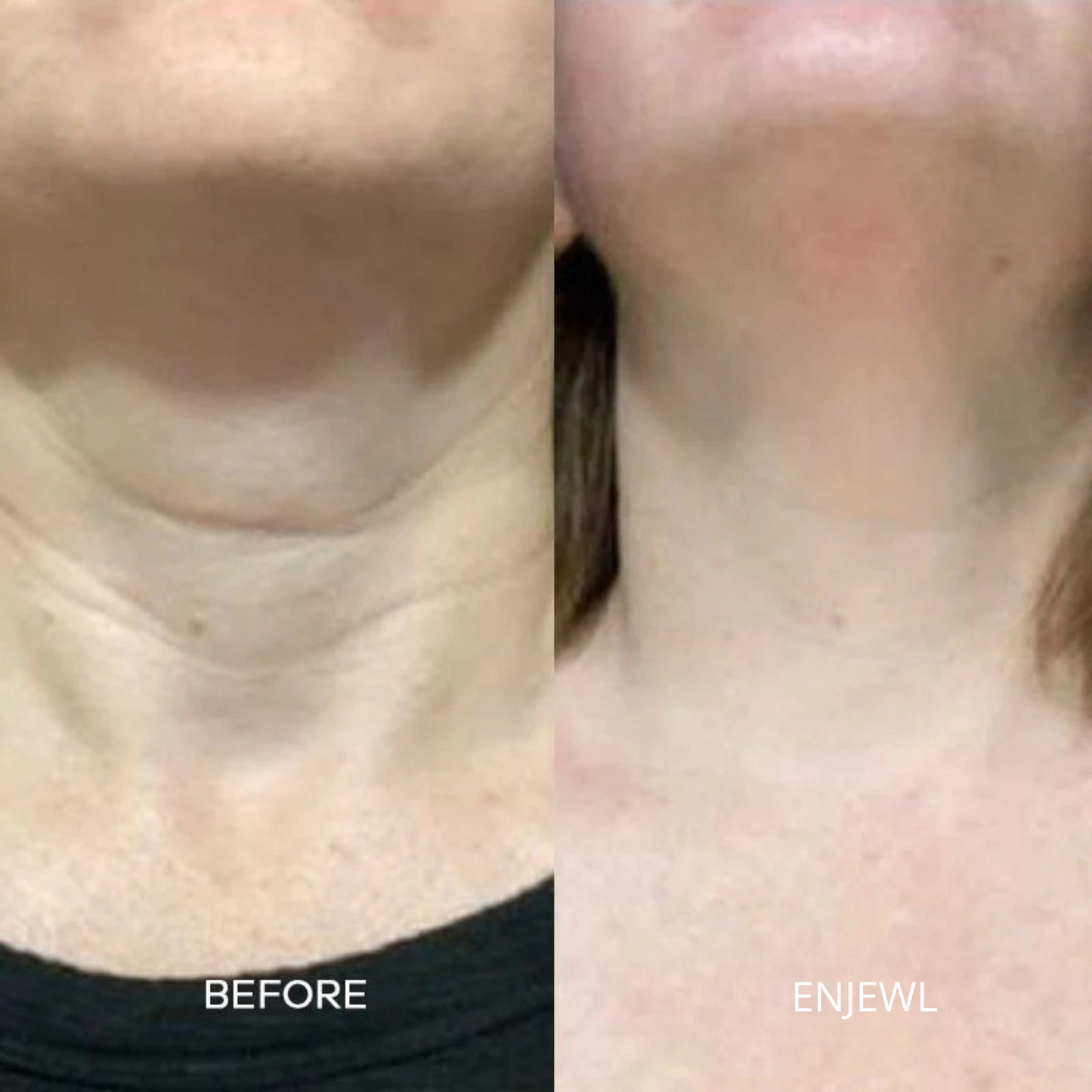 Enjewl™ | Clinical Beauty Filler - Enjewl