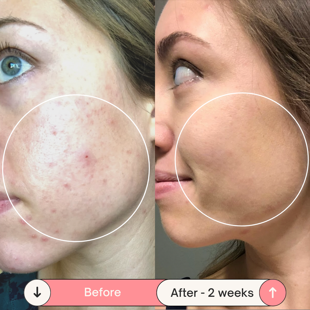 BeautyPro 2.0 - High Frequency Wand - Enjewl