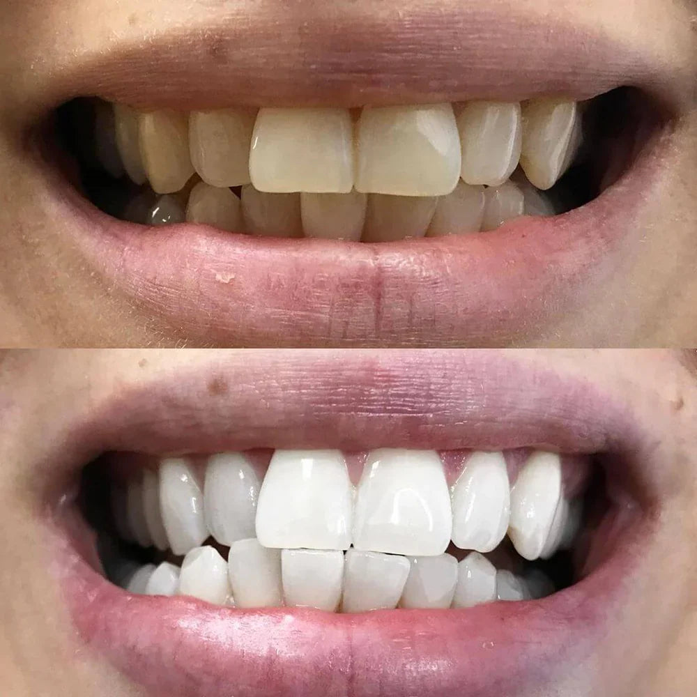 Teeth Whitening Pen - Radiant smile in 10 minutes