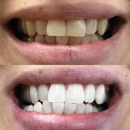 Teeth Whitening Pen - Radiant smile in 10 minutes