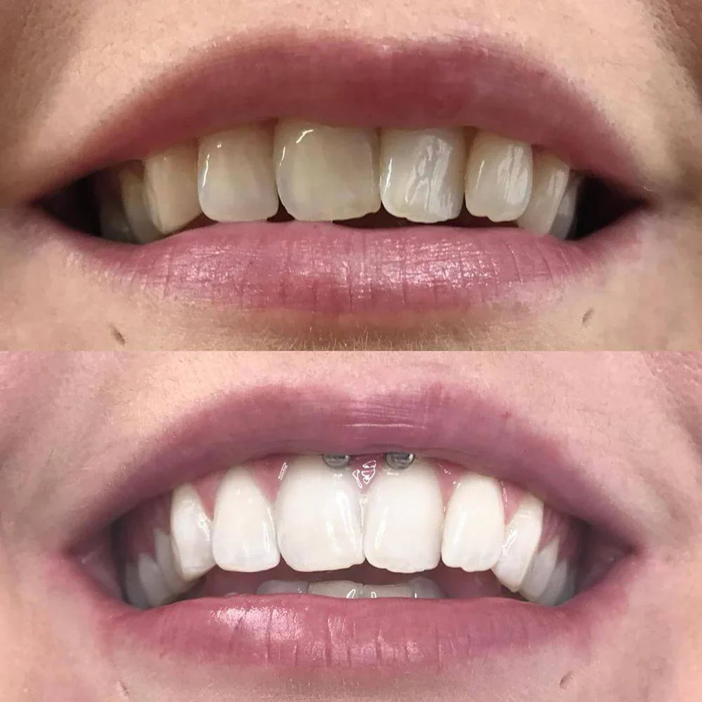 Teeth Whitening Pen - Radiant smile in 10 minutes