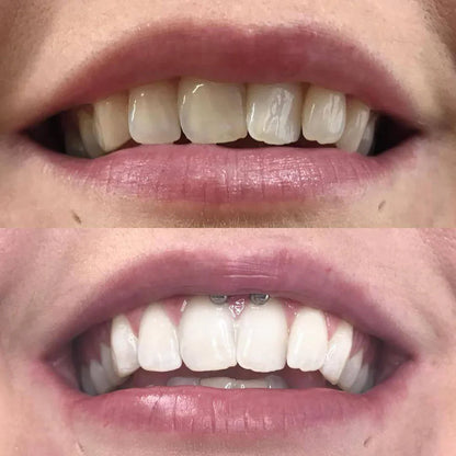 Teeth Whitening Pen - Radiant smile in 10 minutes