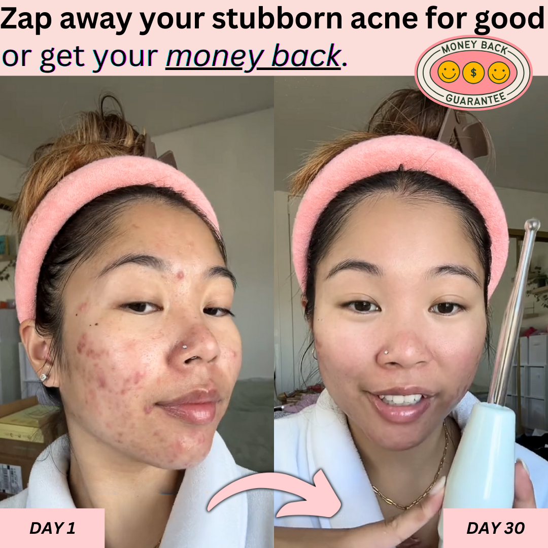 BeautyPro 2.0 - High Frequency Wand - Enjewl