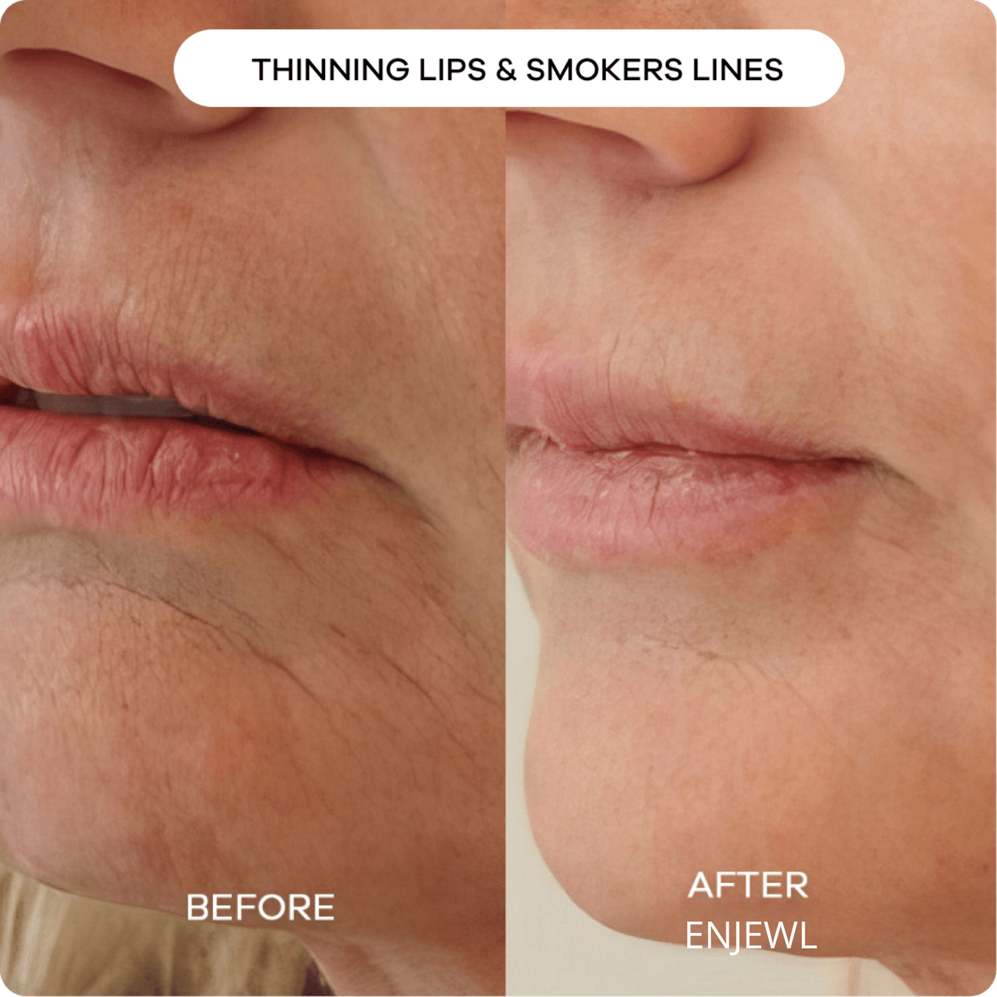 Enjewl™ | Clinical Beauty Filler - Enjewl