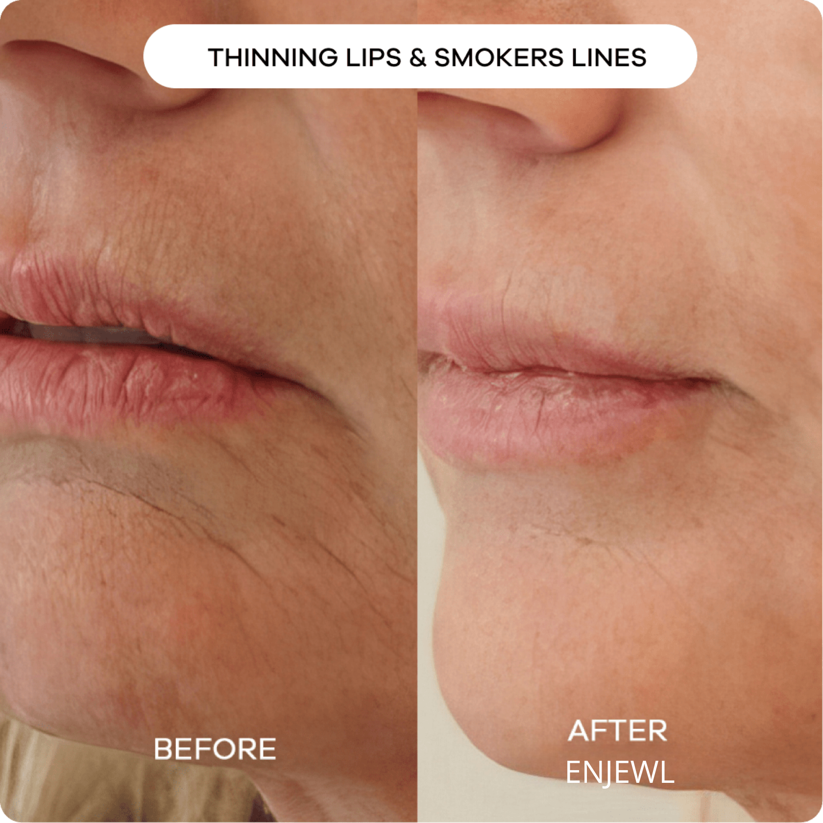 Enjewl™ | Clinical Beauty Filler - Enjewl