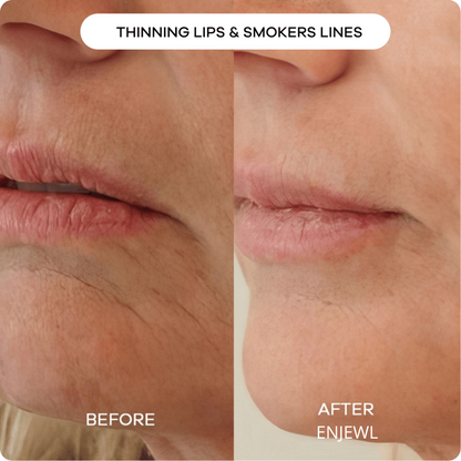 Enjewl™ | Clinical Beauty Filler - Enjewl